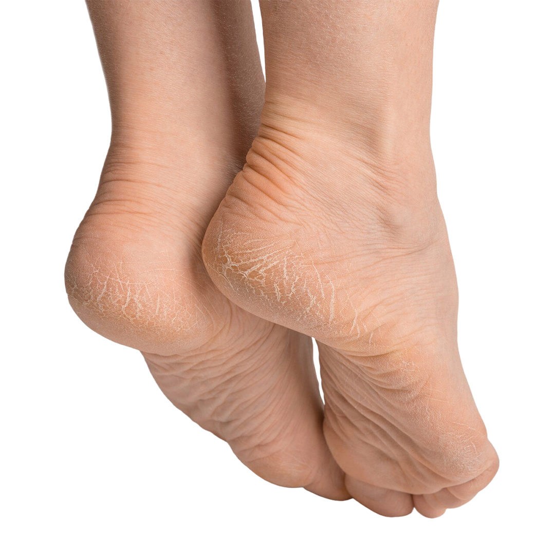 Cracked heel repair available in online  pharmacy qatar, doha 